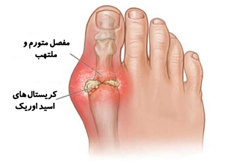 آیا مصرف گوجه فرنگی در ابتلا به نقرس نقش دارد؟