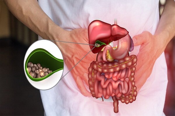 همه چیز درباره سنگ کیسه صفرا؛ چه زمانی به جراحی نیاز داریم؟