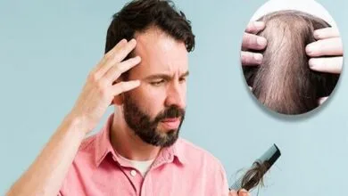 دلیل ریزش موی سکه‌ای چیست؟