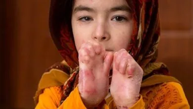 پانسمان‌های تخصصی بیماران پروانه ای تحویل شد