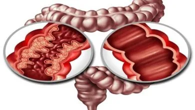 داروهای رایج با بیماری التهابی روده مرتبط نیستند